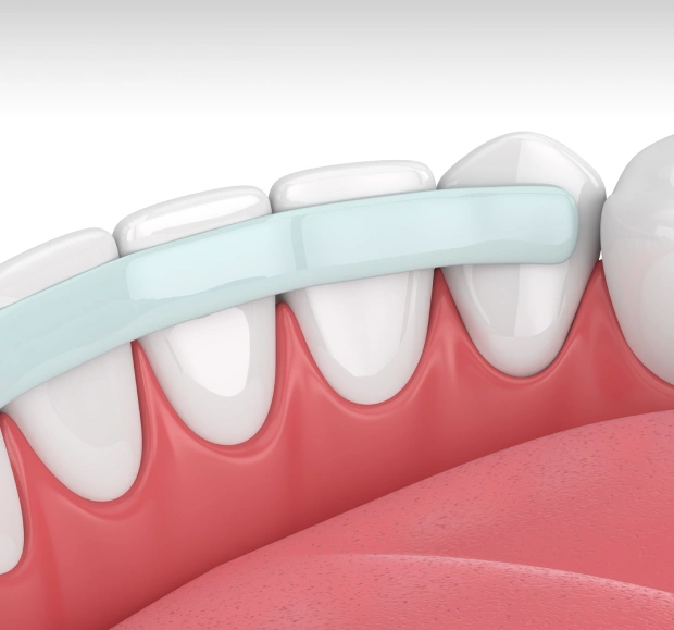 Dental bonding repairing a chipped front tooth