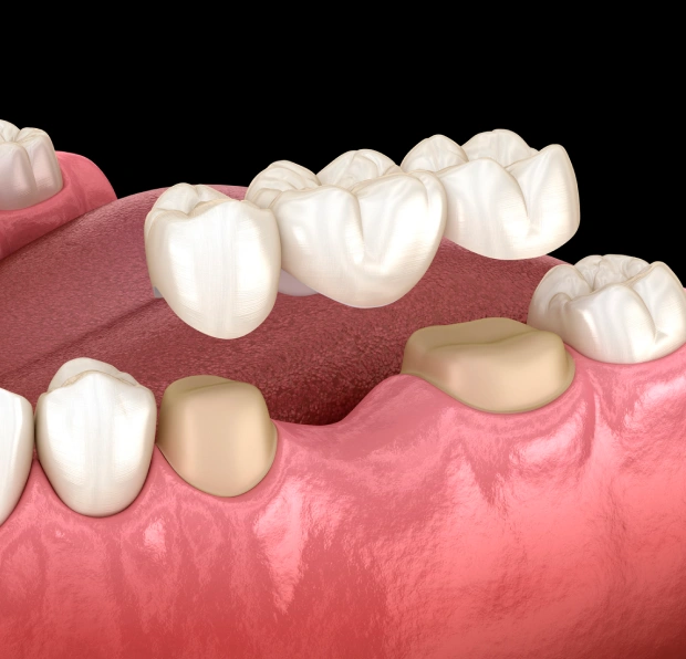 Dental bridge replacing missing teeth