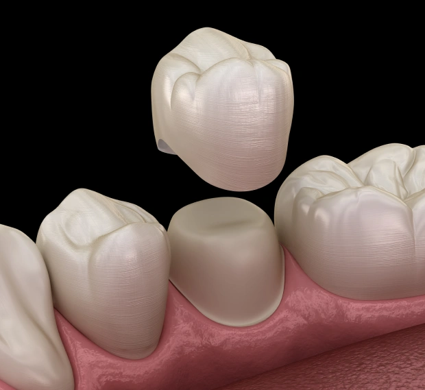 Dental crowns restoring damaged teeth