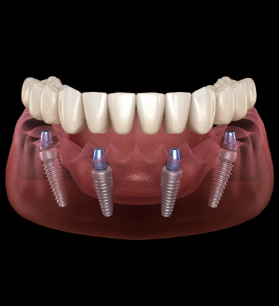 Full-arch dental implant restoration replacing missing teeth