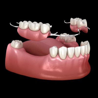 Partial dentures replacing several missing teeth