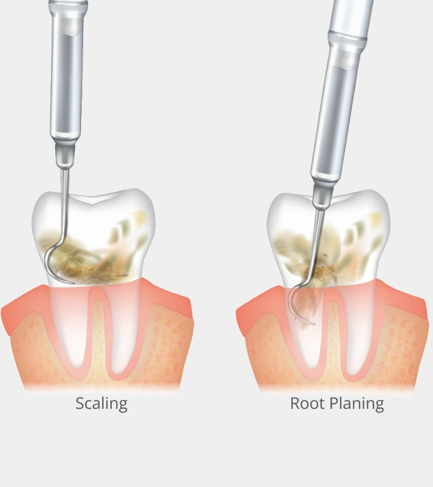 Dental implant illustration showing healing after treatment