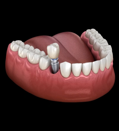 Single dental implant replacing a missing tooth