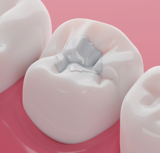 Tooth-colored filling restoring a decayed tooth